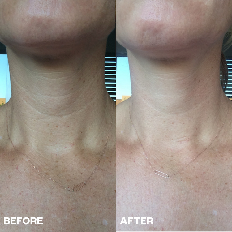 Neck Wrinkle Patch - 1 patch