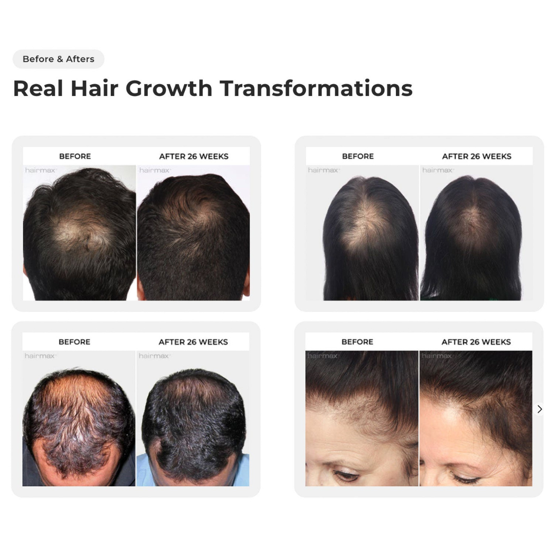 Before and after hair growth transformations showing visible hair density increase.
