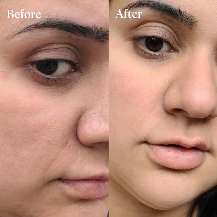 Self Dissolving Microneedle Patches - 4 Pack