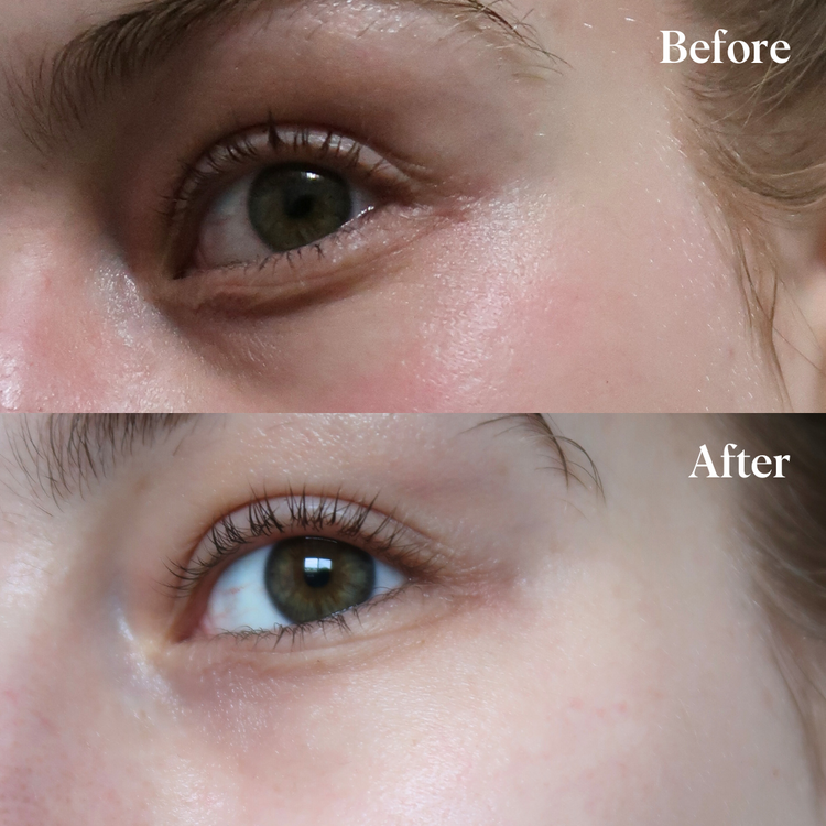 Self Dissolving Microneedle Patches - 4 Pack