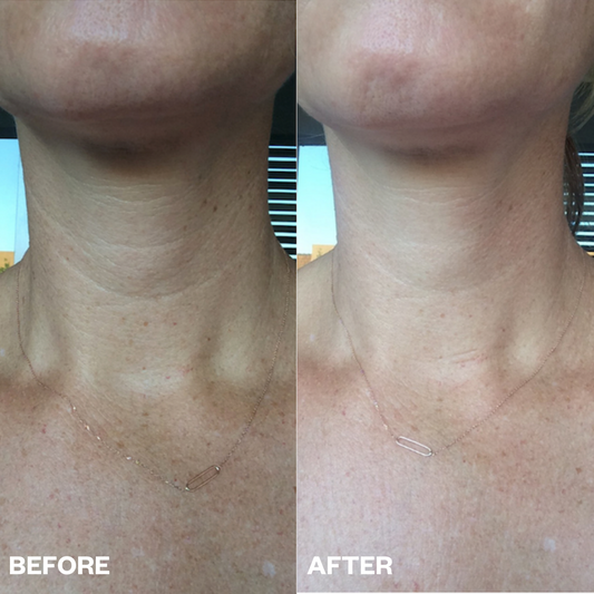 Neck Wrinkle Patch - 1 patch